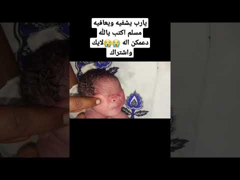 طفل ولد صغير من دون عيون يالله يشافيه