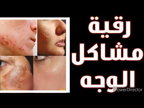 رقية حل لمشاكل الوجه إثر العين والحسد والسحر بقع داكنة حب الشباب حمرة حساسية شحوبة حساسية