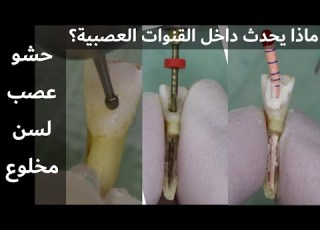  خطوات حشو العصب للأسنان الأمامية وماذا يحدث داخل القنوات العصبية Root Canal Treatment For Teeth