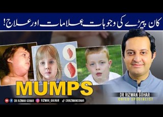  MUMPS SYMPTOMS HOME TREATMENT Mumps Treatment