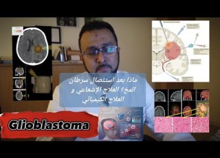  ماذا بعد استئصال سرطان المخ العلاج الإشعاعي و العلاج الكيميائي الضوابط و التوقيت Glioblastoma