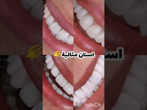 انا اسنان الانياب البارزة وانتو