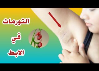  الغدد اللمفاوية في الابط أسبابها و لماذا يجب الحذر منها تورمات الإبط