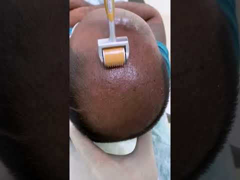 PRP Best Hair Loss Treatment Hair Loss Treatment Derma Roller Hair Regrowth Skinaa Clinic