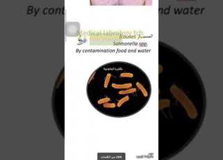  مرض التيفود Typhoid المرض التشخيص الاعراض العلاج
