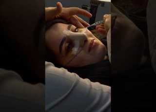  ليش تصير كدمات تحت العين بعد عملية الأنف شنو السبب و شلون تروح بسرعه