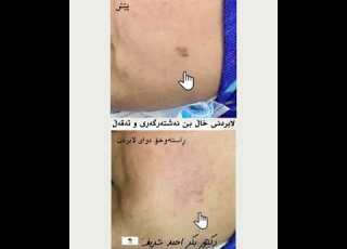 لابردنی خاڵ بێ نەشتەرگەری و تەقەڵ