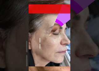 قبل و بعد فوتونا