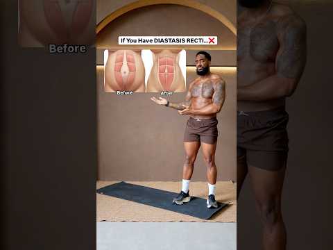 If You Have DIASTASIS RECTI Do This