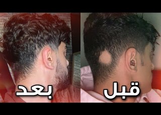 قصتي مع مرض الثعلبة وكيف عالجتها