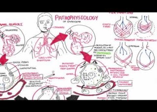 Emphysema Pathophysiology COPD