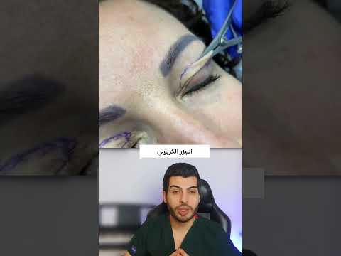 جراحة تجميلية للجفن جراحة تجميلية تجميل الجفون الليزر الكربوني Microneedling Laserco2 د مصعب حسوا جراحة تجميلية للجفن جراحة تجميلية تجميل الجفون الليزر الكربوني Microneedling Laserco2 د مصعب حسوا