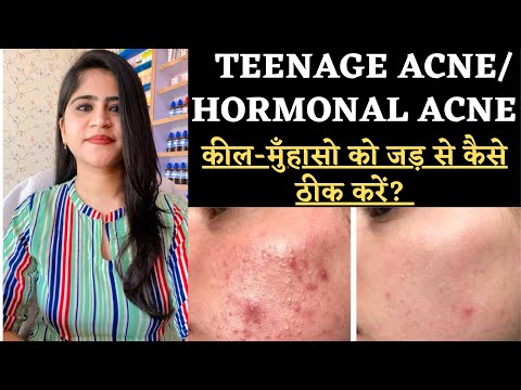 Teenage Acne And Hormonal Acne Treatment German Homeopathic Medicine Drarwabohra Teenage Acne And Hormonal Acne Treatment German Homeopathic Medicine Drarwabohra