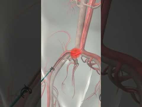 Learn How Cardiac Catheterization Works