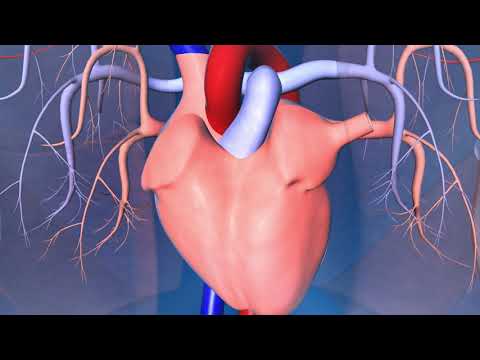 Catheter Ablation What Is It And How Does It Help An Irregular Heart Beat Catheter Ablation What Is It And How Does It Help An Irregular Heart Beat