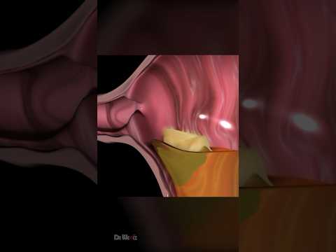 ASMR Acid Reflux