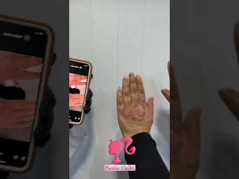 علاج الصدفية معنا في مركز باربي