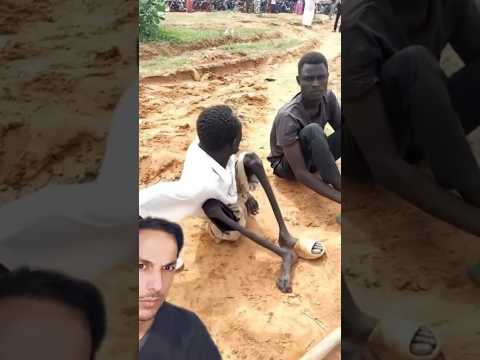 The Long Term Effects Of Polio Polio Virus Muscle Vaccine Medicalstudent Doctor Dr Disease The Long Term Effects Of Polio Polio Virus Muscle Vaccine Medicalstudent Doctor Dr Disease