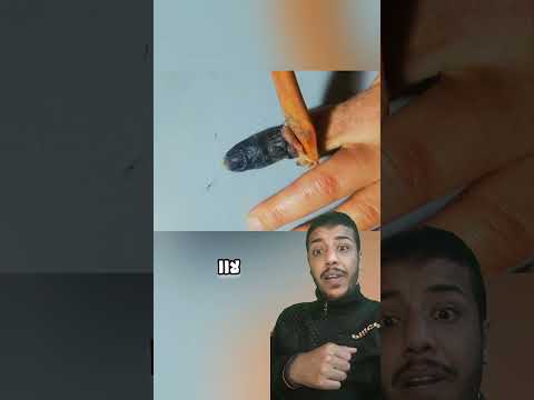 ماذا يحدث حين تصيب ضربة صقيع الاطراف Shorts