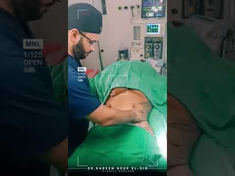 شد البطن بعد العملية مباشرة