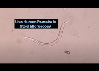 Strongyloides In Stool Microscopy
