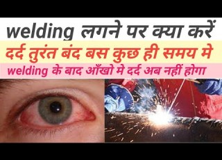  Welding Flash Eyes Weling Pain Welding Lagne Par Kya Kare