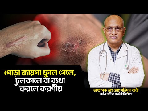 What To Do If The Burn Area Is Swollen Itchy Or Painful Burn Scar Treatment Advice