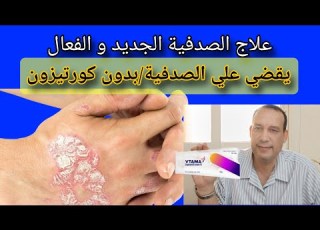 علاج الصدفية الجديد بدون كورتيزون يعيد الجلد الي شكله الطبيعي