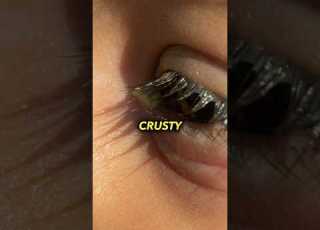 Crusty Eyes Youtubeshorts Bacteria Sleep Health