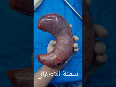 اجراء التكميم لطفلة عمرها ١١ سنة سمنة الأطفال