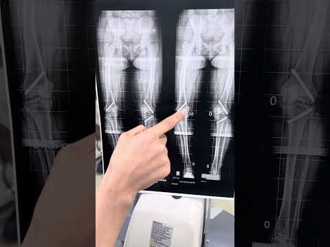 نقاش مفيد لحاله تم استعدال التقوس بالساقين عن طريق التدخل المحدود والتحكم فى مركز النمو