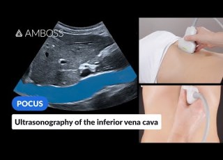 Point Of Care Ultrasound Of The Inferior Vena Cava IVC AMBOSS Video