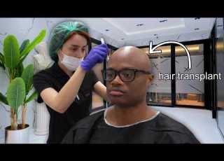 I Went To Turkey For A 10 000 HAIR TRANSPLANT And This Is What Happened
