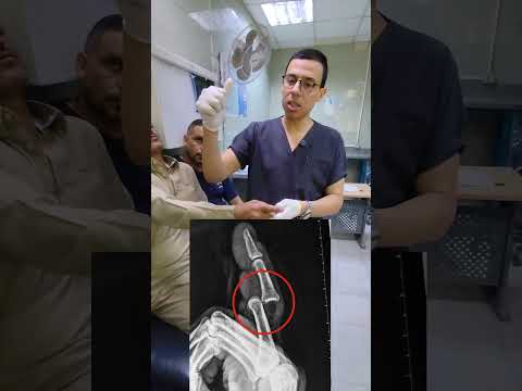 الطريقه العلميه الصحيحه لرد خلع الاصبع Phalangeal Dislocation Reduction