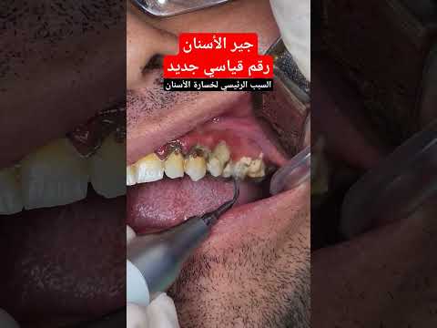 تنظيف جير الاسنان