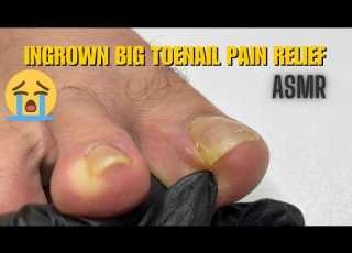  Ingrown Big Toenail Pain Relief Pedicure Cleaning Pedicure Asmr