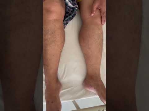 Pseudohypertrophy In Muscular Dystrophy