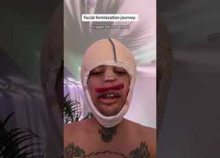 Facial Feminization Results Over 3 Months Trans Facialfeminizationsurgery