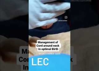  Management Of Cord Around Neck In Birth LEC Optimal Birth Course Lillieecenter