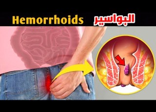 ازاي تعرف ان عندك بواسير How Do You Know You Have Hemorrhoids
