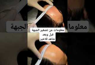 عملية تصغير الجبهة للمتعالجة قبل وبعد