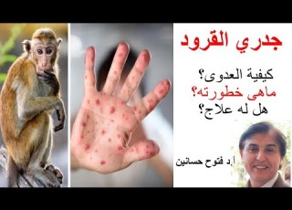 جدري القرود كيفية العدوى ماهى خطورته هل له علاج