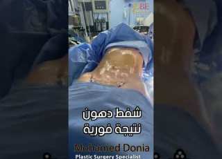 اسرع طريقة للتخسيس شفط دهون البطن دكتور محمد دنيا دكتور تجميل تنسق قوام شفط دهون جسم مثالي