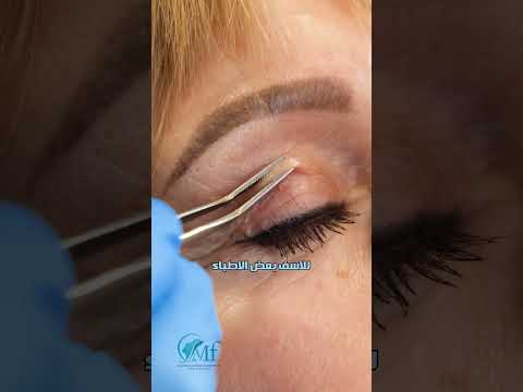 عملية شد الجفون د محمد فاروق المغربي عملية شد الجفون د محمد فاروق المغربي