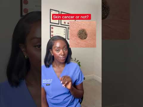 Could Your Mole Be Skin Cancer