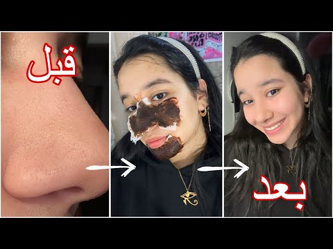 التخلص من الرؤوس السوداء بمكونين فقط في كل بيت من اول مره هتتخلصي من كل الرؤوس تجهيزات العيد