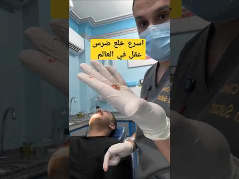 شاهد اسرع خلع ضرس عقل علوي في العالم في اقل من 5ثواني Dentist Dr Abdullah Sultan Dentist Dentist