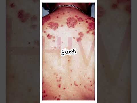 اعراض الايدز الاوليه بالترتيب ٩ علامات تخبرك انك مصاب بفيروس نقص المناعة البشرية HIV اعراض الايدز الاوليه بالترتيب ٩ علامات تخبرك انك مصاب بفيروس نقص المناعة البشرية HIV