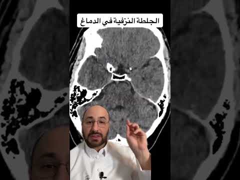 الجلطة النزفية داخل الدماغ