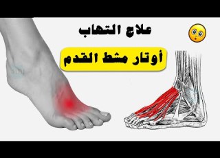 علاج التهاب أوتار مشط القدم